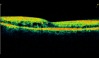 Ocular Imaging - Diabetic Retinopathy showing cystoids oedema, hard exudates and retinal thickening.